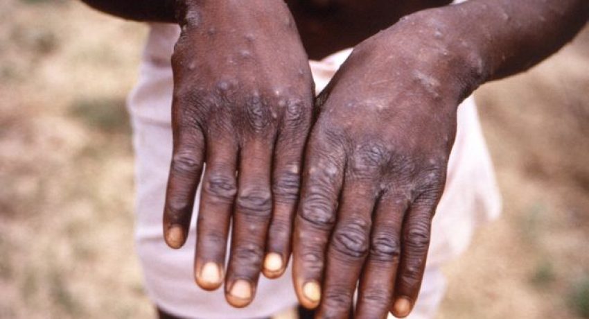 FILE PHOTO: An image created during an investigation into an outbreak of monkeypox, which took place in the Democratic Republic of the Congo (DRC), 1996 to 1997, shows the hands of a patient with a rash due to monkeypox, in this undated image obtained by Reuters on May 18, 2022. CDC/Brian W.J. Mahy/Handout via REUTERS THIS IMAGE HAS BEEN SUPPLIED BY A THIRD PARTY./File Photo